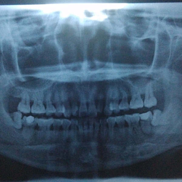 什么是智齿引起牙根疼,什么是智齿智齿有哪些类型