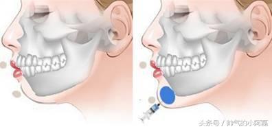 玻尿酸微整形丰下巴多少钱一针,下巴微整形要多少钱