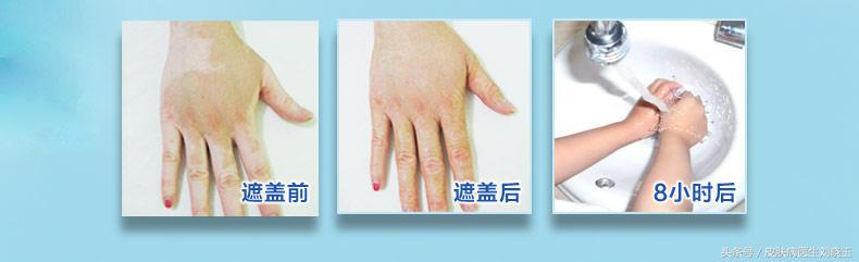 白癜风发病早期有什么手段能控制,对白癜风最有效的治疗