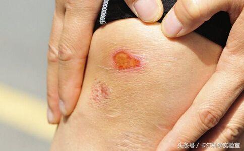 卡尔带你了解了解：伤口上撒盐，到底是什么情况？