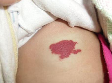 新生儿身上好多青色胎记怎么回事,新生儿很多胎记怎么回事