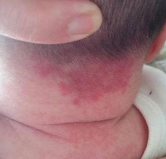 新生儿身上好多青色胎记怎么回事,新生儿很多胎记怎么回事