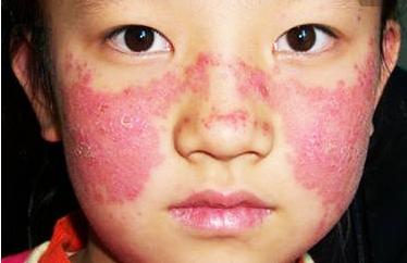 红斑狼疮早期怎么养生,红斑狼疮发现得早可以治好么