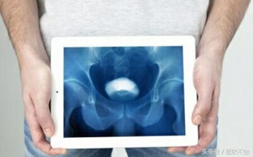 膀胱癌常见的发病因素,男性膀胱癌怎么引起的