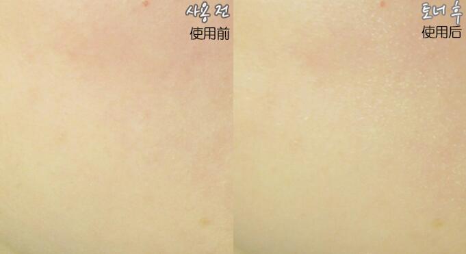 韩国做皮肤多少钱,在韩国大概一天要花多少钱