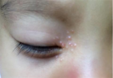 孩子身上长水瘊子怎么治疗,水瘊子最简单的去除方法