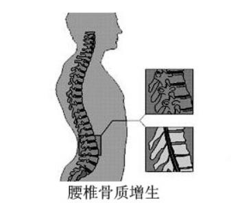 骨刺和骨质增生的区别图,骨刺与骨质增生有哪些区别