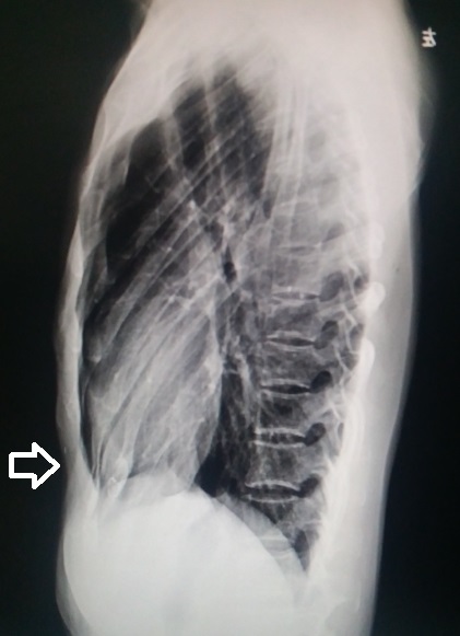 鸡胸手术恢复过程痛苦吗,鸡胸22岁手术还有效果吗