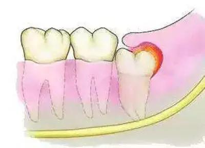长智齿避免感染,长智齿如果不拔疼痛忍过去可以吗