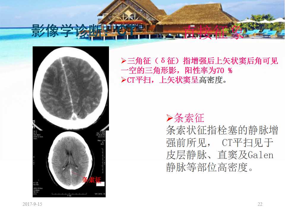 颅内静脉窦血栓形成怎么治疗,颅内静脉窦血栓怎么治疗