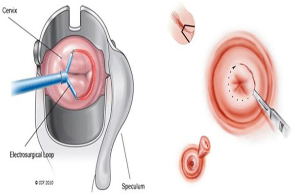 案例分享：宫颈上皮内瘤变的诊断和治疗，该如何预防宫颈癌？