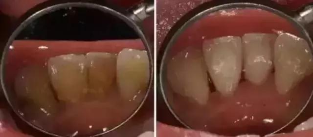 牙齿松动是怎么回事该怎么办,牙龈肿痛牙齿松动是怎么回事