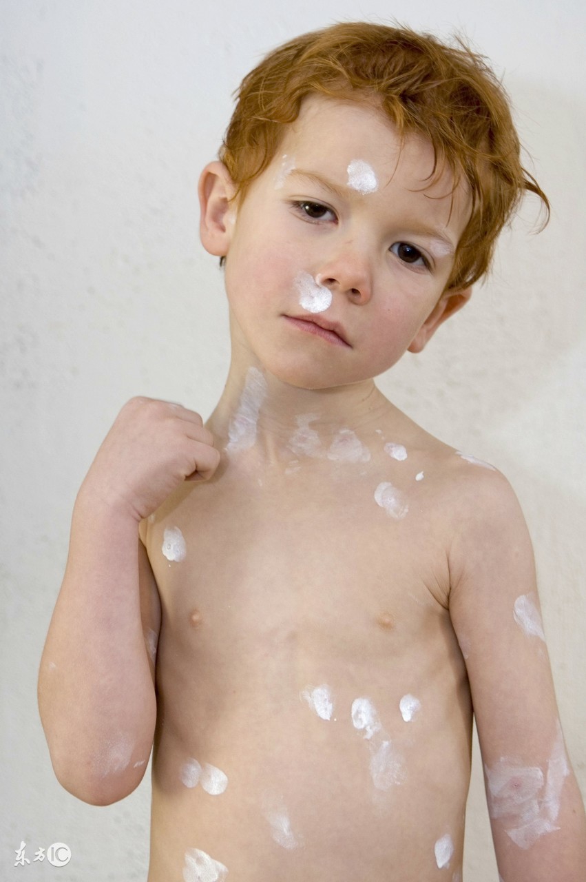 妈妈得了水痘宝宝怎么预防,大人护理儿童水痘的防范措施