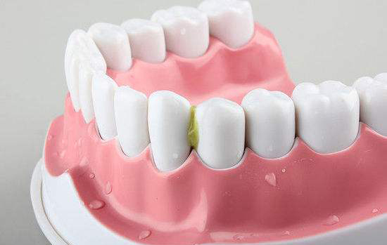 吃饭老塞牙有方法解决吗,吃饭老是塞牙能去治吗