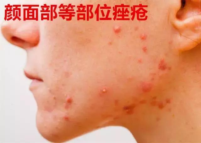 感染导致肾病加重,感染加重的肾病还能恢复吗