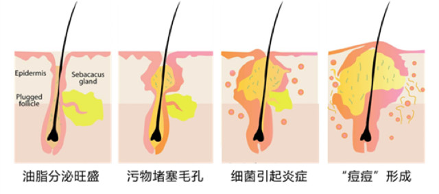 皮肤暗疮处理,暗疮痘痘的正确消除方式