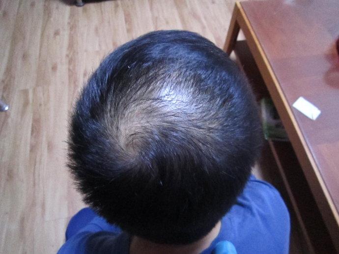 脱发秃顶严重男生怎么办,40岁男脱发秃顶多年了怎么治