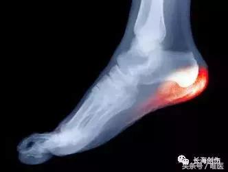 足底筋膜炎中医诊断是什么,足底筋膜炎诊疗