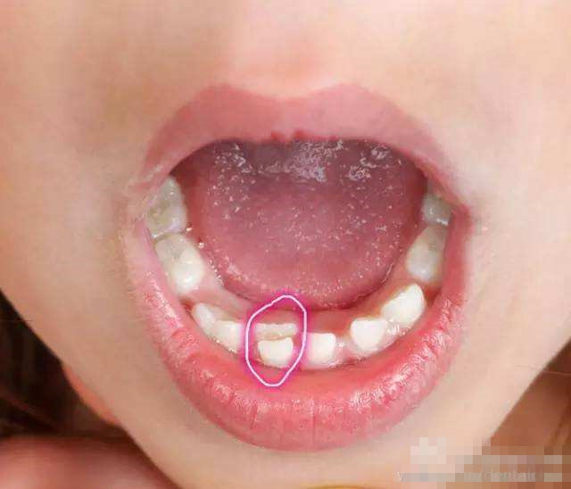 心疼龋齿宝宝——看口腔科比看感冒还多的漫漫看牙路