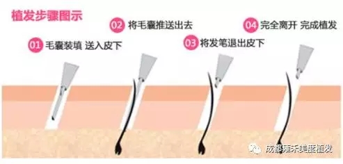 雄脱怎么解决根源问题,雄脱最好的治愈方法