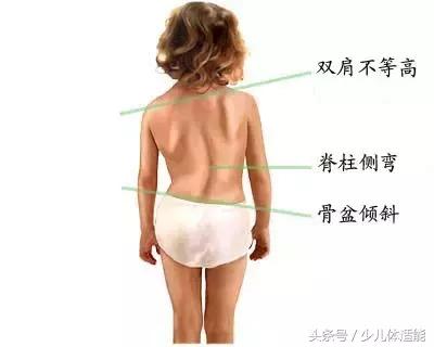 新苗脊柱侧弯预防中心是做什么的,用哑铃练背能预防脊柱侧弯