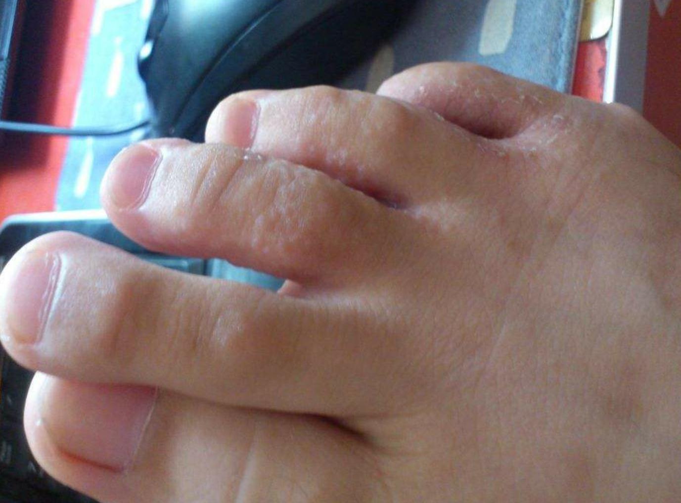 脚气、长水泡、瘙痒等!一招轻松搞定!