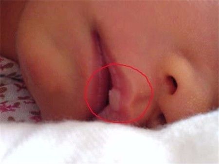 新生儿嘴上有白点怎么回事,新生儿嘴上有白泡