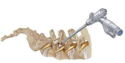 治疗颈椎病最好的骨科医院,骨科医生如何治好自己的颈椎病