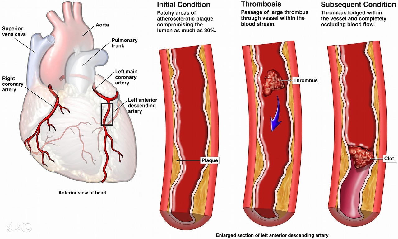 心脏病突发用什么方法急救,心脏病突发最好的急救方式