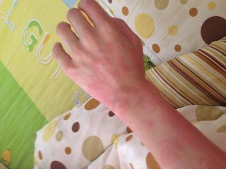 一个彻底根除荨麻疹的土方法,超详细的荨麻疹治疗方案