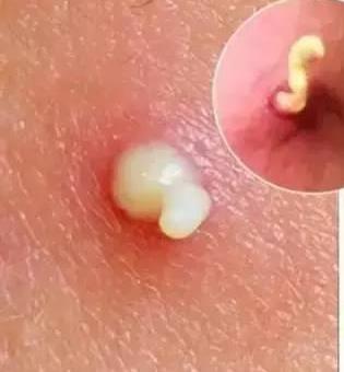 痘痘里面挤出来的白色东西是什么,痘痘挤出来白色硬粒后再挤出血