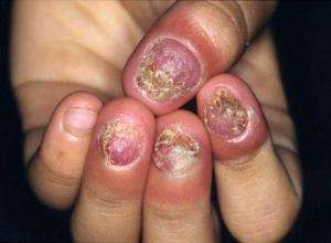 灰指甲是怎么形成的有什么危害,灰指甲是什么样子对身体有何危害