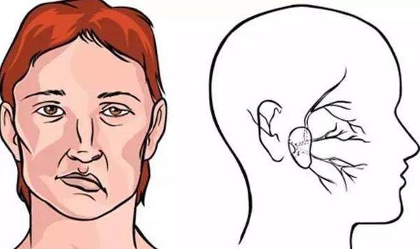 治疗面瘫最有效穴位,老人面瘫怎么治疗最好最快最有效