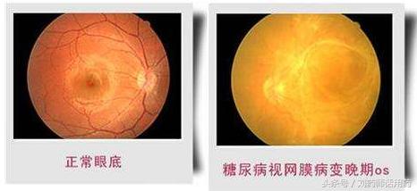 空腹血糖高吃什么来降血糖,空腹血糖高了怎么办如何降糖