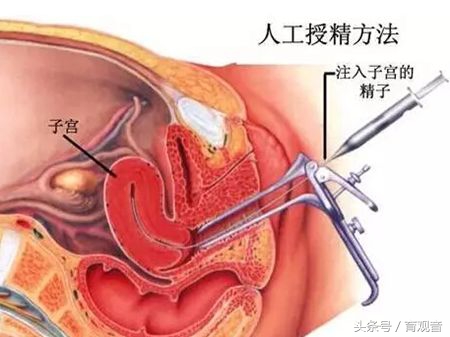 宝妈想要孩子？人工授精复杂？（叫你老公也进来，别以为没关系）