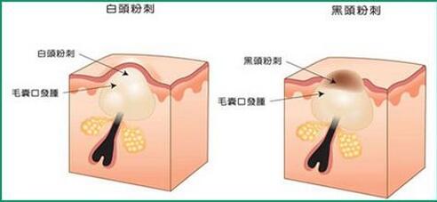 身体上粉刺很大很硬怎么去除,怎样解决皮肤里的粉刺