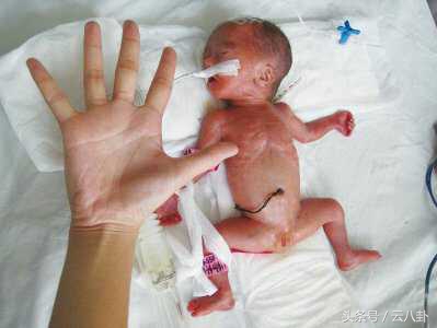 孕妇本以为小小的阴道炎没事竟是胎儿的天敌，害早产宝宝成这样