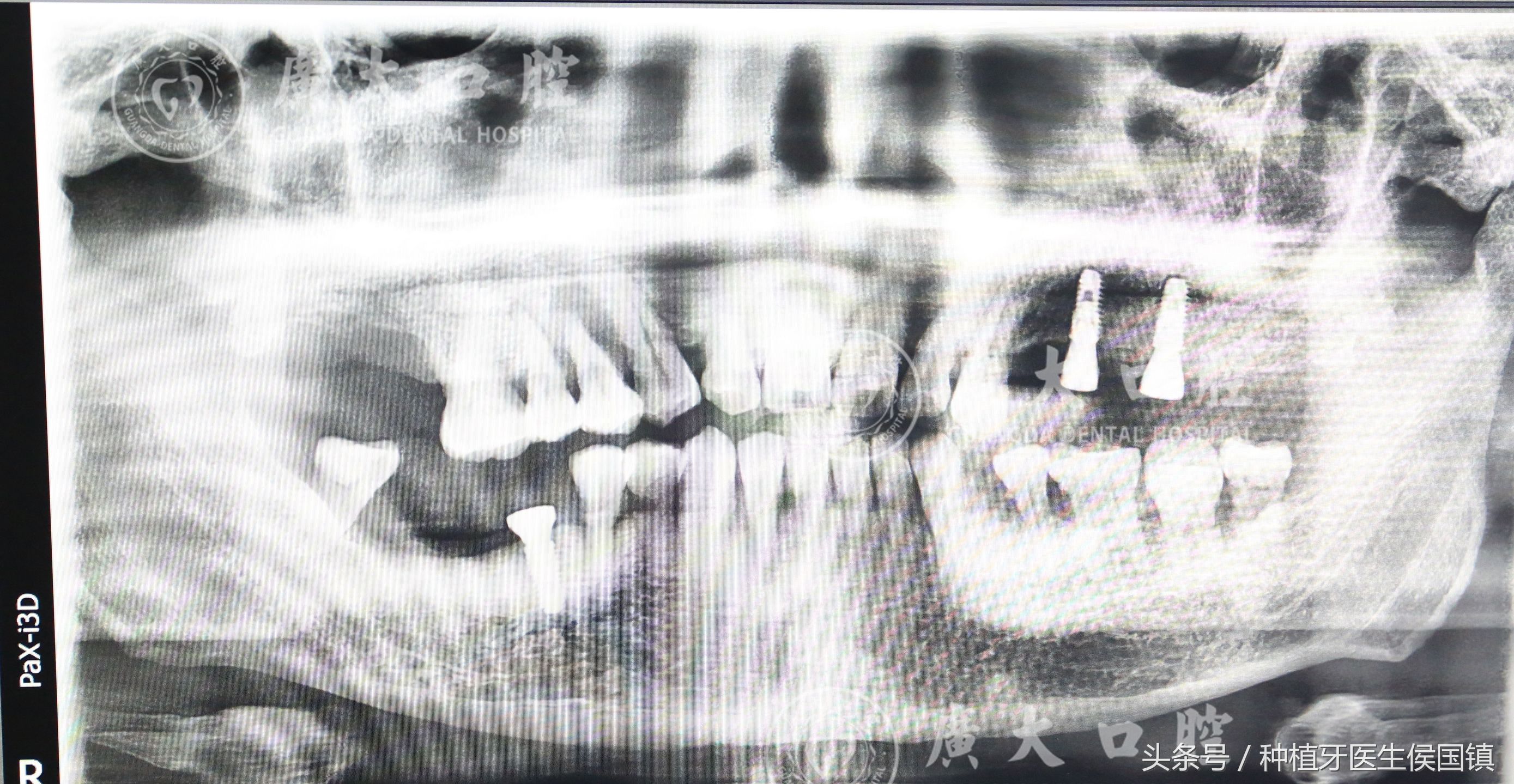 种植牙上颌窦提升术的并发症,瑞典种植牙astre术后并发症