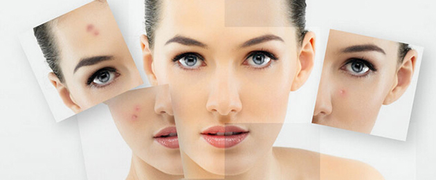 闭合性痘痘最佳治疗方法,闭合性痘痘里面有粉刺