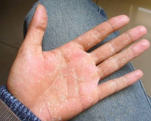 手掌癣脱皮干裂,双手对称蜕皮裂口是不是手癣