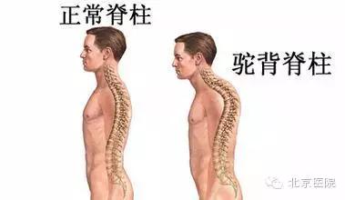 骨科医生教你改善驼背,北京哪家医院治疗脊椎弯曲驼背