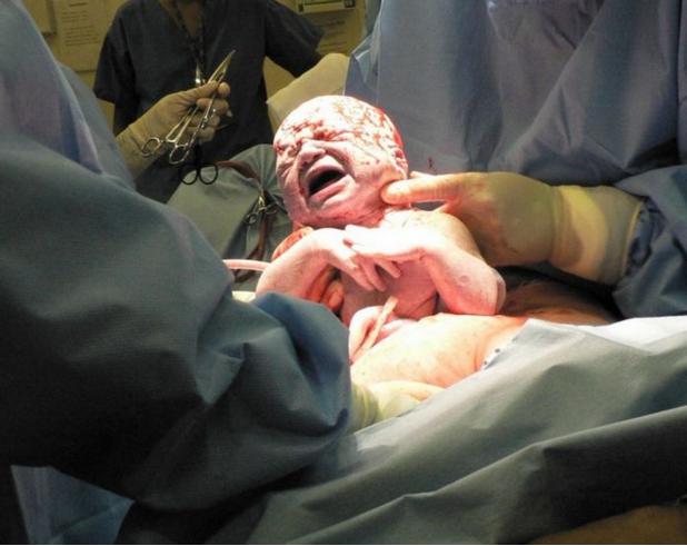 实拍胎儿剖腹产过程，“捧在手里怕摔了，含在嘴里怕化了”！