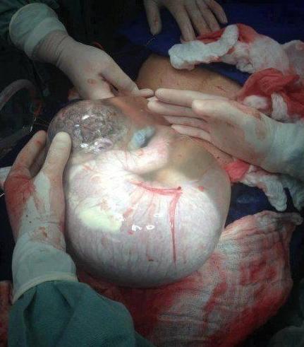 实拍胎儿剖腹产过程，“捧在手里怕摔了，含在嘴里怕化了”！