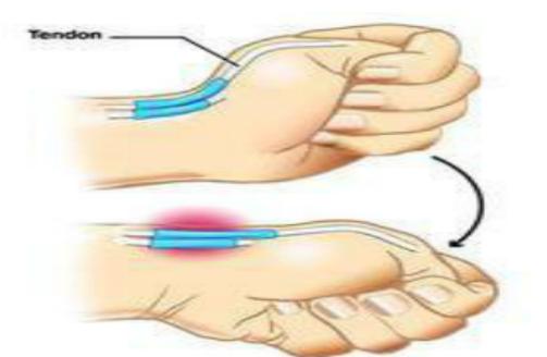 手指腱鞘炎怎么治,膏药能治腱鞘炎吗