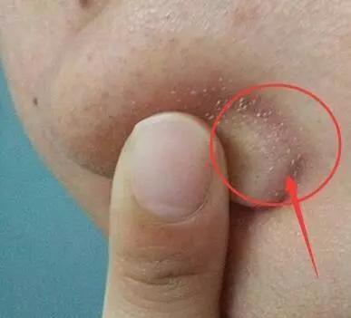 脸上能挤出白色小东西是什么,脸上鼻头挤出白色颗粒