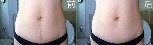 深扒“网红”神油,8周改善妊娠纹和疤痕~