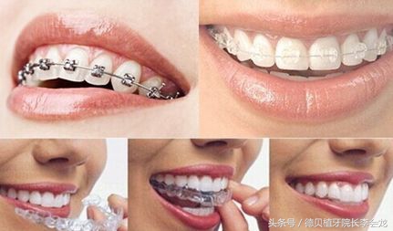 牙齿不齐矫正牙齿的最佳年龄,牙齿排列不齐有必要矫正吗