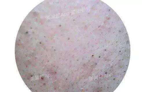 粉刺没有处理好变成硬疙瘩,痘痘粉刺消不掉