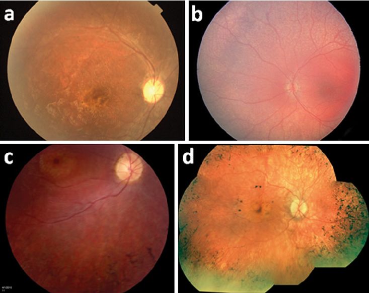 美国基因药物治疗视网膜疾病,美国基因治疗夜盲进展