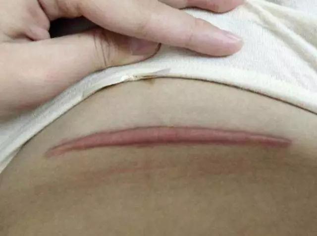 二胎剖腹产后伤口,剖腹产妈妈伤口右边流脓了怎么办
